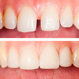 Cosmetic dentistry