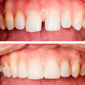 dental restoration richmond dental suite
